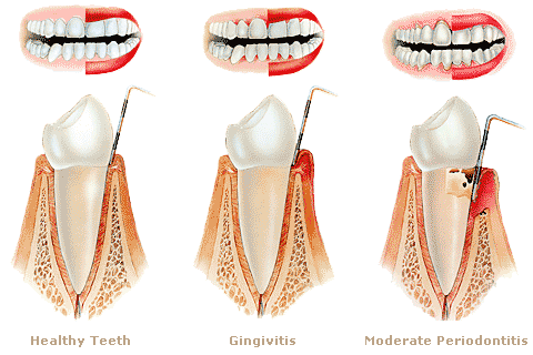 Gum Disease explained